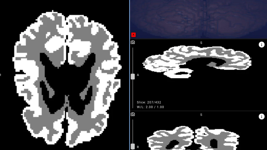 Yapay Zekâ Serebral Palsiyi erken teşhisi